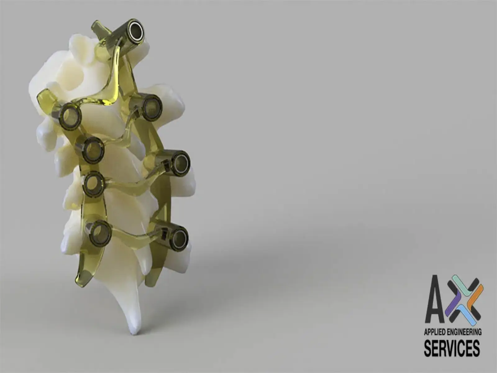 Guía quirúrgica personalizada montada sobre un modelo de columna vertebral