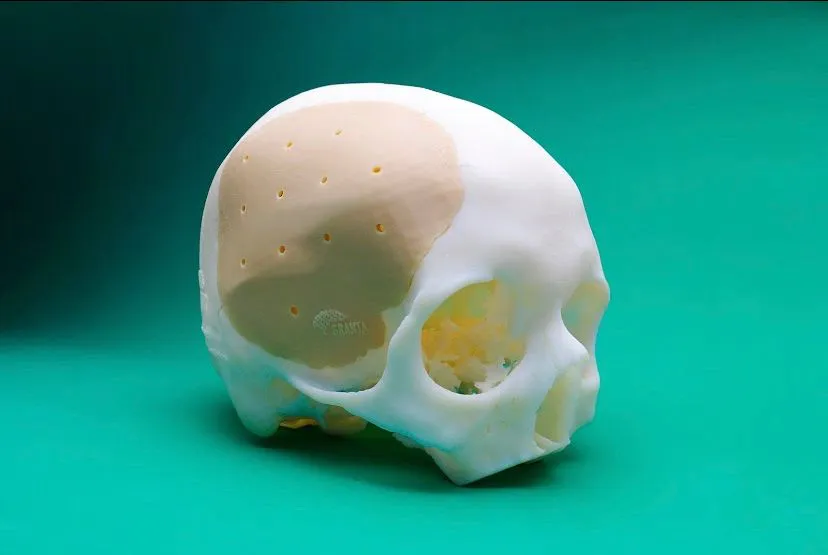 PEEK Natura S® implant fitted on a skull model — anterior and lateral views